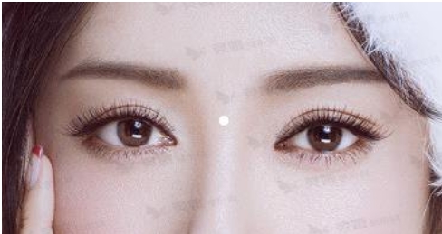 苏薇洁做双眼皮修复吗？坐诊医院简介-案例果分享！知识大盘点~