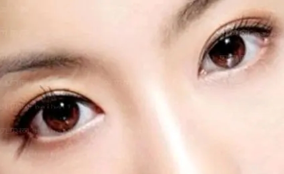 北京协和医院黄久佐做双眼皮怎么样?案例恢复过程~求美评价到底如何?