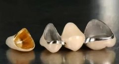 镍铬烤瓷牙和钴铬烤瓷牙哪个好？二者区别有哪些？