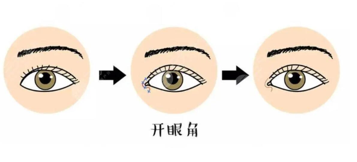 开眼角后如何护理？效果怎么样？来看详细介绍！