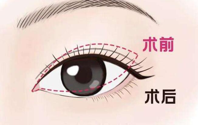 开眼角后如何护理？效果怎么样？来看详细介绍！