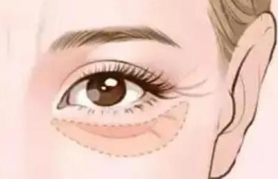 如何消除眼部皱纹?通过补充水分,防晒,合理饮食详细情况来了解吧