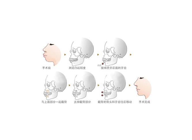 广州时光医院正颌怎么样?费用价格2023_侯振杰医生简介_案例效果