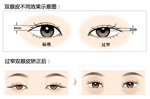 刘韶瑞修复双眼皮怎么样?广州可玉主打眼部整形医生介绍!附案例反馈_价格