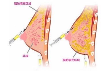 北京八大处刘春军做自体脂肪隆胸多少钱?北京美胸大咖实力揭秘,必看!