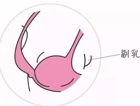 协和医院朱琳副乳手术风格如何？副乳切除手术疼不疼？手术案例全过程~