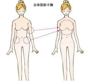 自体脂肪丰胸手术费大概要多少钱?医生从业履历|技术优势点击解锁!