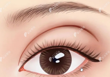 苏薇洁做双眼皮修复吗？医生教你如何避免术后留疤！@姐妹收藏起来~