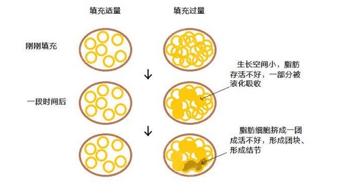 自体脂肪丰胸恢复期多久？手术之后护理的方式是什么？费用贵吗？