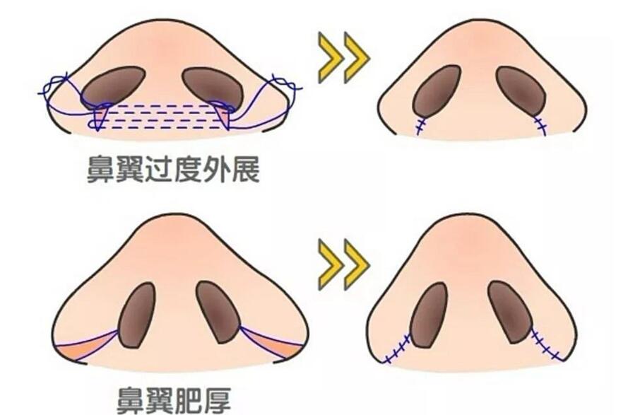 如何缩小鼻子？缩鼻子术后有什么注意事项吗？