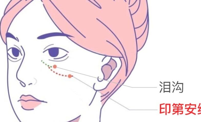 玻尿酸填充泪沟多久可以恢复自然？术后效果能维持多长时间？