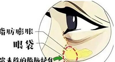怎样去除黑眼圈和眼袋？来看一下怎么祛除吧！