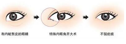 开眼角有危险吗？术后的注意事项是是什么？