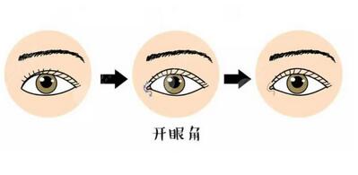 开眼角怎么样？不仅是放大眼睛！快来深入了解下吧！