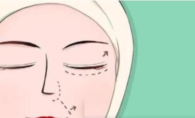 女子割双眼皮失败老公闹离婚事件是怎么回事?来看看事件的全过程!