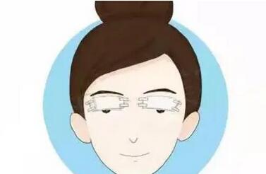 成都八大处胡琼华双眼皮真人案例图来袭！附双眼皮案例