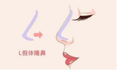 贺光照隆鼻的技术好不好?看看案例就全明白了
