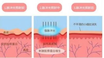 光子嫩肤副作用有哪些？做完嫩肤感受如何？来看看真实案例！