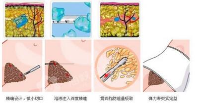 协和医院整形科价位高不高?医院价格表附双眼皮案例展示