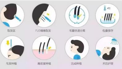 种植头发一般多少钱啊？做完植发后如何护理头皮
