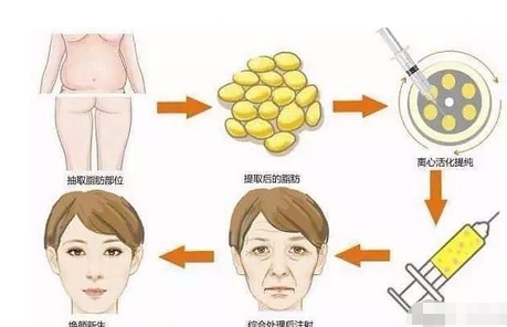 广州曙光做自体脂肪填充脸部果如何？皱纹、苹果肌凹陷怎么改良？自体脂肪填充方式测评！