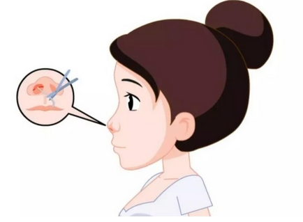 广州曙光做鼻子陈日国医生怎么样?超全手术常识介绍,术前扫盲必看!