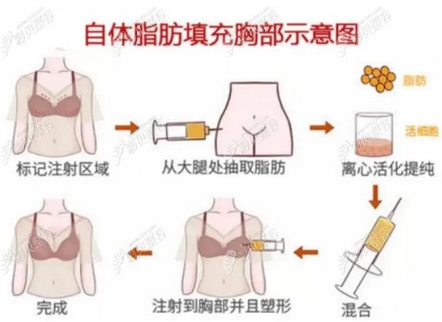 自体脂肪丰胸安全可靠吗？手术费用是多少呢？注意事项有哪些？