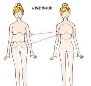 自体脂肪丰胸安全可靠吗？手术费用是多少呢？注意事项有哪些？