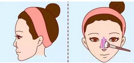 广州曙光做鼻子怎么样？隆鼻案例分享~是正规机构吗，医生怎么样？