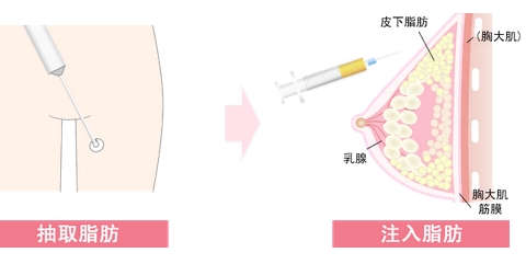 八大处刘春军脂肪隆胸价格如何?这个医生技术好?分享专家|案例信息!