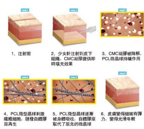 注射胶原蛋白和玻尿酸的区别有哪些？哪个维持更久一点，副作用小一点？