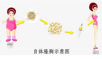 自体脂肪丰胸的副作用和危害有哪些？费用是多少？传统技术优势值得信赖~