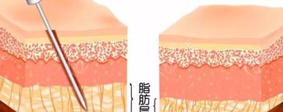 水动力吸脂和环吸哪个效果比较好,来参考吧!