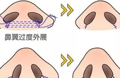 鼻翼肥大怎么办?通过手术调节,非手术调节等等