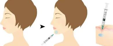 玻尿酸双下巴能维持多久？与个人的护理及医生的经验等方面有关系！