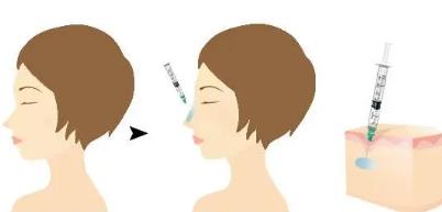 双美胶原蛋白隆鼻价格有哪些,价格因素影响?来参考一下吧!