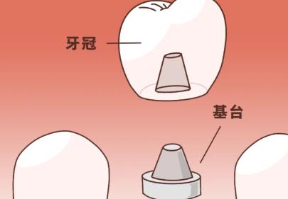 现在种一颗牙要多少钱？有哪方面的因素影响？