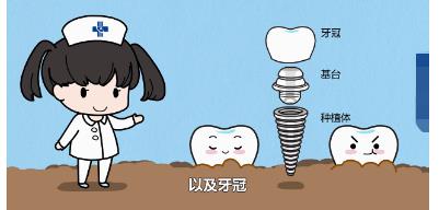 种植牙大概价位是多少?哪些的因素影响?