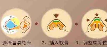 自体软骨隆鼻好不好,有哪些优点?