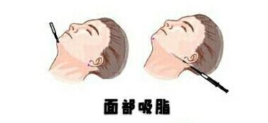 激光溶脂瘦脸怎么样?术前术后注意事项你一定要了解!