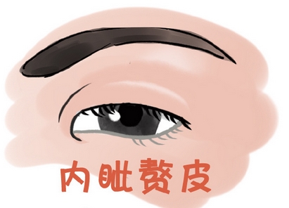 张冰洁修复内眼角案例怎么样？大咖医生帮您解除关于内眼角的各种疑虑！