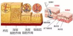 胳膊抽脂多久开始消肿？纤细胳膊速成指南~
