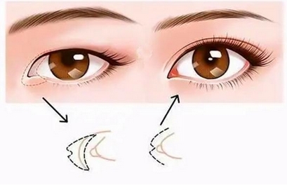 张冰洁眼角修复技术怎么样？实力测评这位业内大咖，看看技术有何不同！