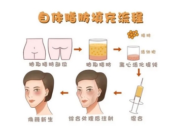 胡华新面部脂肪移植做的怎么样？坐诊医院介绍~面部脂肪移植求美评价！