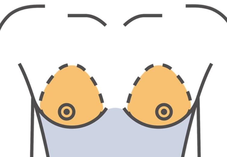 男人变性隆胸安全吗?手术过程及安全性公布!