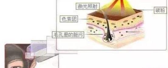 做黑脸娃娃嫩肤怎么样?调节过程是怎么样的?术后注意事项分享