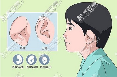 董立维小耳再造如何？求美有发言权！亲身经历_手术过程分享！
