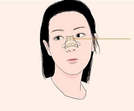斯楼斌脂肪填充鼻子？推崇高级有自然~隆鼻案例给你呈现！