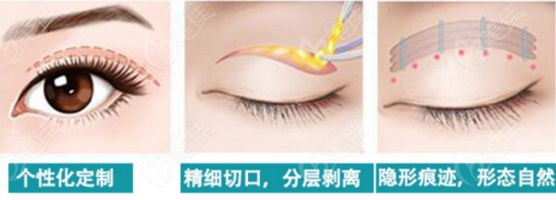 八大处杨庆华做修复双眼皮吗？北京眼整形专家技术测评~有什么技术难点吗？