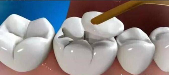 矫正牙齿一般要花多少钱？隐形、金属材料价格不同！正畸避坑~